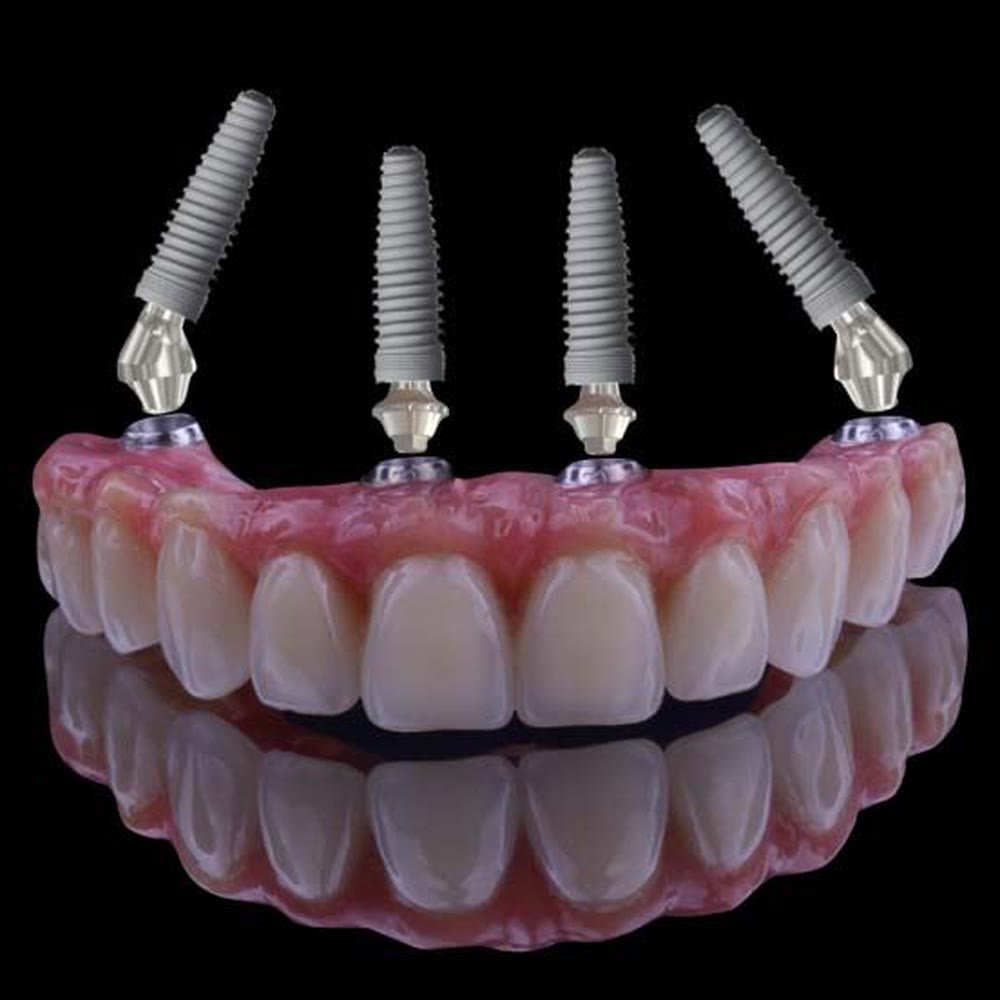 Modelo do protocolo All-on-4 com quatro implantes