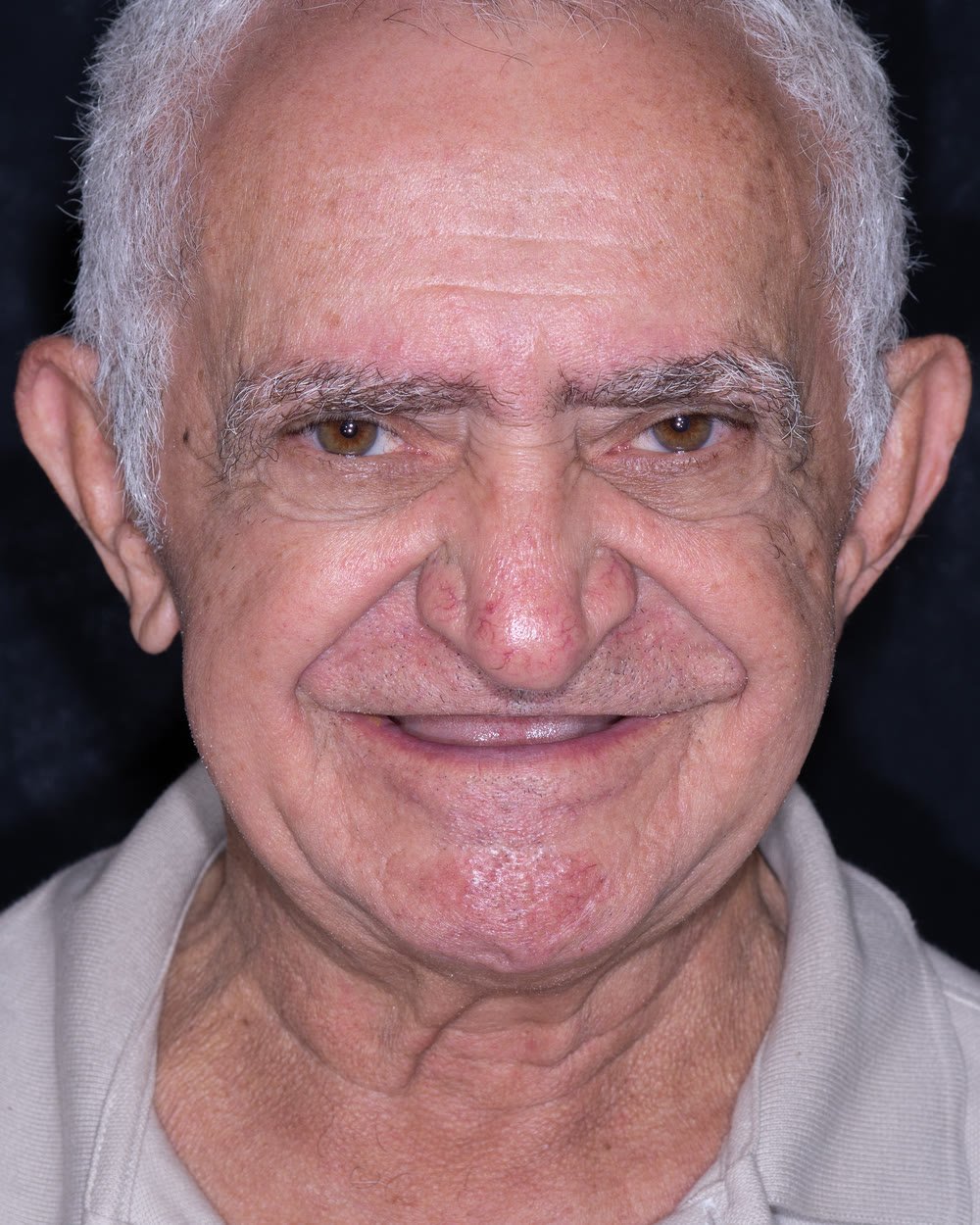 Osvaldo antes do tratamento, sem os dentes superiores