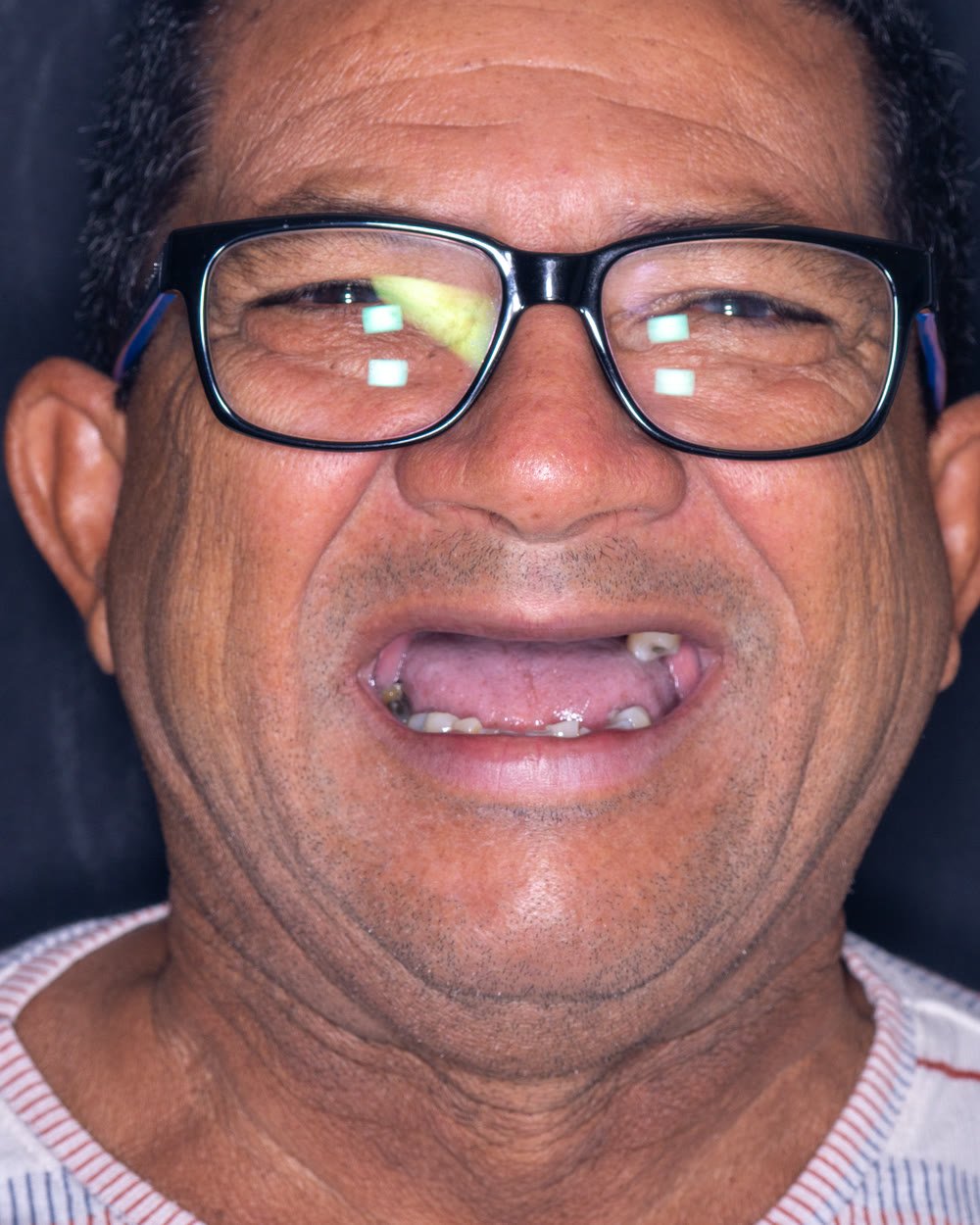 Eliésio antes do tratamento, com poucos dentes