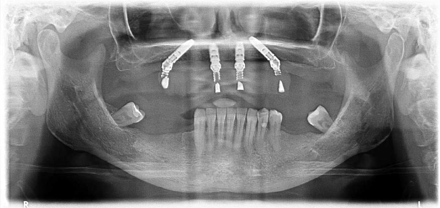 Raio-x panorâmico mostrando os quatro implantes do protocolo All-on-4 fixados em posição estratégica no maxilar